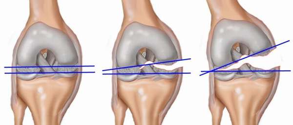 Разрыв связок колена